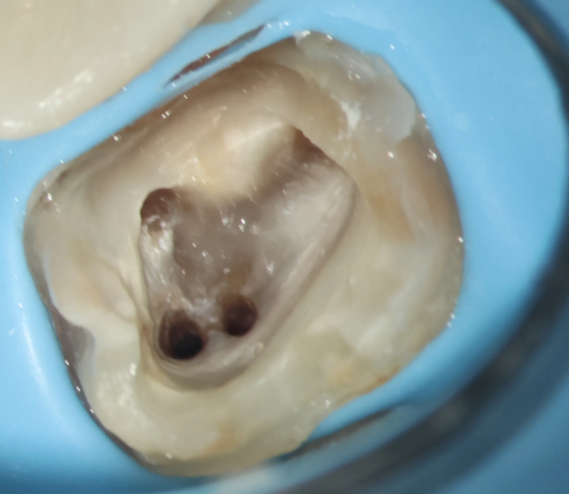 Cleaned canals with advanced irrigation, found missed MB2